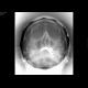 Chronic sinusitis of the left maxillary sinus: X-ray - Plain radiograph